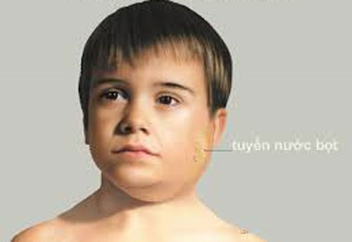 Nhận biết dấu hiệu đặc trưng của quai bị. Khi bị nhiễm vi rút quai bị, phần lớn bệnh nhân thấy khó chịu từ 1 - 2 ngày trước khi các triệu chứng xuất hiện. Bệnh nhân bị sốt cao (39 – 400C) trong 3 - 4 ngày, chảy nước bọt, sưng vùng mang tai, dấu hiệu dễ nhận biết nhất là má sưng to, có thể sưng một bên mặt rồi lan sang bên kia hoặc sưng hai bên cùng một lúc.