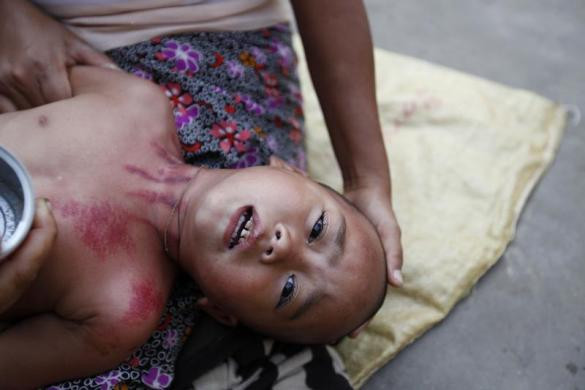 Một em bé bị sốt rét đang được điều trị tại Myitkyina, Myanmar.