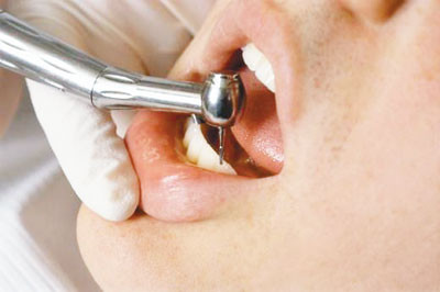 Sau đó sẽ dùng khoan chuyên dụng để khoan một hoặc vài lỗ nhỏ trên răng đúng bằng đường kính của viên đá (tùy theo nhu cầu gắn một viên hay nhiều viên).
