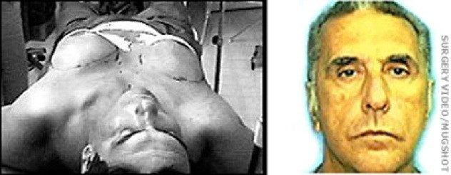 Năm 1999, cảnh sát Miami đã bắt giữ một bác sĩ giả hành nghề y khoa không có giấy phép. Ông này đã cấy nguyên cả một cặp vú đàn bà vào cơ thể nhà thể thao Baez.
