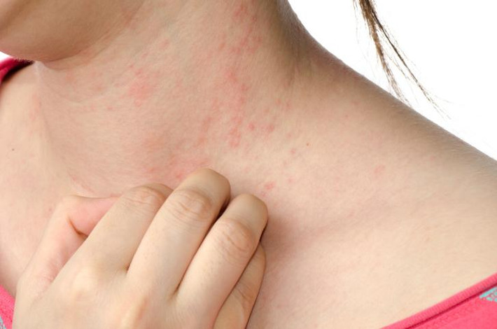 Những kem này có thể làm dị ứng, tổn thương da, da mỏng, teo da, rối loạn sắc tố . Tẩy da thường dẫn đến nguy cơ teo da do mất tế bào, nguy hiểm hơn cả là các mao mạch bị lộ rõ, da bị ửng đỏ, khả năng phục hồi là rất khó. Da bị lột tẩy, dẫn đến mất cân bằng độ ẩm, gây khô da, về lâu dài thì tiến trình lão hóa tự nhiên sẽ đến nhanh hơn.