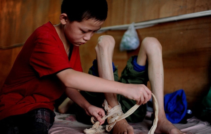 Cậu bé 12 tuổi thay băng cho bố.