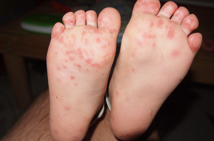 Hiện không có thuốc chủng ngừa nhằm chống lại các virus gây bệnh nhưng nỗ lực duy trì vệ sinh cá nhân sạch sẽ, khử trùng các vật dụng xung quanh bé sẽ giảm đáng kể nguy cơ mắc bệnh.