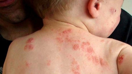 Sữa mẹ có thể giúp làm giảm khó chịu từ những vết phát ban ở cả người lớn lẫn trẻ em. Xoa nhẹ lên da vài lần trong ngày bạn sẽ thấy tác dụng ngay.