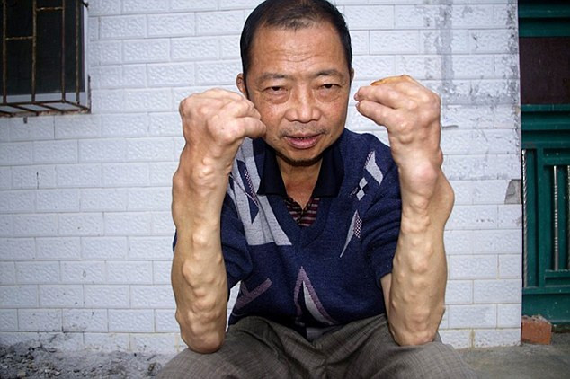 Huang Guiqiang, 58 tuổi chia sẻ: "Các u cục trên cơ thể tôi vô cùng đau đớn, tôi thậm chí không thể làm được gì".