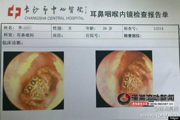 Một phụ nữ ở Trường Sa Trung Quốc thấy ngứa tai kinh khủng đã phải tới bệnh viện để khám. Thật ngạc nhiên khi các bác sĩ gắp ra một con nhện từ ống tay trái của bà và con nhện này vẫn còn sống dù đã ở trong tai 5 ngày.