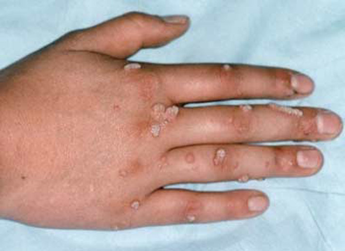 Xuất hiện mụn cóc trên cơ thể. Ngoài bộ phận sinh dục, vi rút HPV còn khiến khu vực lòng bàn chân, dưới móng tay, da tay hoặc mặt xuất hiện mụn cóc. Loại mụn này khá nhỏ, nhiều thịt và u lồi trên da. Màu sắc thường thấy là hồng hoặc tan, sần sùi khi chạm vào.