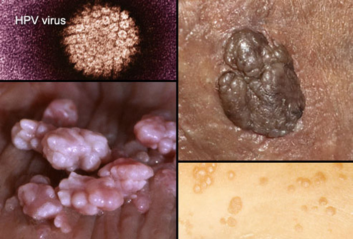 Ngoài bộ phận sinh dục, vi rút HPV còn ảnh hưởng đến khu vực háng với biểu hiện sưng hạch bạch huyết. Hiện tượng này xuất hiện vài tuần hoặc lâu hơn sau khi quan hệ tình dục với người nhiễm vi rút.