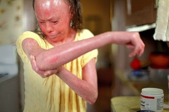Tình trạng trên cũng khiến Hunter gặp cử động khó khăn như lớp da quá dày nên cô không cong ngón tay của mình lại được như những người bình thường.