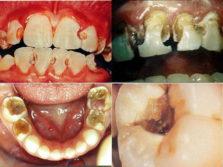Mẻ răng. Vấn đề này bao gồm răng bị hư hỏng, mòn hoặc các vết hàn trước đây bị bong ra. Một trong những trường hợp gây đau đớn nhất là vụn răng cắm vào các mô mềm trong khoang miệng, gây viêm loét. Cảm giác nhức nhối này sớm được loại bỏ khi bạn đến các phòng khám nha khoa để gắp chúng ra. Nếu là mảnh răng nhỏ, đôi khi nó sẽ tự bung ra và vết loét sẽ lành.