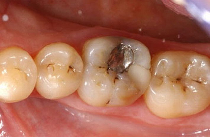 Đáng lưu ý, không phải cứ ăn nhiều thực phẩm ngọt như đường, bánh kẹo mới gây tác động xấu. Việc ăn nhiều trái ngọt, ăn vặt lắt nhắt cả ngày cũng làm răng bị sâu. Vấn đề bắt nguồn từ lượng đường và axit có trong chúng gây hình thành mảng bám quanh răng và dần dần phá hủy chúng. Bạn nên súc miệng sau mỗi lần ăn sẽ mang lại tác dụng ngăn ngừa đáng kể. Ngoài ra, bạn cũng nên giảm lượng tiêu thụ đường và duy trì đánh răng hai lần một ngày.