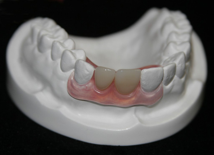 Các vấn đề liên quan đến răng giả. Một trong những vấn đề có thể xảy ra là hiện tượng loét lợi khi đeo răng giả. Trong trường hợp này cần nhanh chóng chỉnh lại vị trí hàm răng. Theo thời gian, đeo răng giả sẽ trở nên dễ dàng hơn. Bạn lưu ý thường xuyên vệ sinh chúng bằng nước lạnh với kem đánh răng. Lúc về đêm, nên tháo răng ra ngâm vào nước sạch để giúp lợi được nghỉ ngơi.