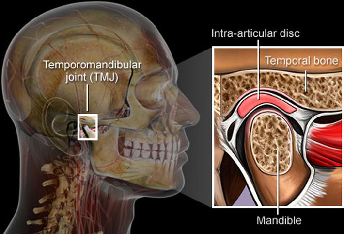 TMJ. Vấn đề này còn được gọi là hội chứng chung thái dương, gây đau đớn dữ dội ở khu vực hàm, mặt, tai hoặc cổ. TMJ hình thành do thói quen nghiến răng, mài răng. Tuy nhiên, những tác động của TMJ lên cơ thể thường không giống nhau. Nó gây đau, nhức đầu, chóng mặt hoặc đôi khi khiến người bệnh cảm thấy khó nuốt. Bệnh dễ dàng được chữa khỏi bằng cách uống thuốc hoặc tiến hành phẫu thuật.