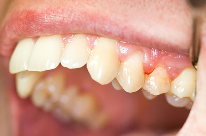 2 - Bệnh nướu răng: thói quen sử dụng thuốc lá gây nên hiện tượng xuất hiện nhiều mảng bám trong miệng người hút. Những vi khuẩn có trong mảng bám này tấn công mạnh vào nướu răng. Bên cạnh đó, người hút thuốc cũng có nồng độ oxy trong máu thấp dẫn đến tình trạng các vết thương trong khoang miệng rất khó lành, gây nên tình trạng nhiễm trùng nướu. So với người không “dính dáng” đến khói thuốc, người “nghiện” thuốc lá có tỷ lệ mắc nướu răng lớn hơn nhiều.