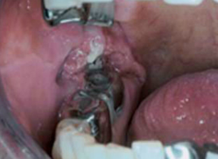Răng chuyển màu và phần lợi bị lở loét là hậu quả của việc lạm dụng thuốc lá và rượu bia của một bệnh nhân ở tuổi 78. Bên cạnh việc chịu sự phiền toái từ khối u, hơi thở của bà cũng rất khó chịu khiến mọi người tỏ ra ngại ngần mỗi khi tiếp xúc.