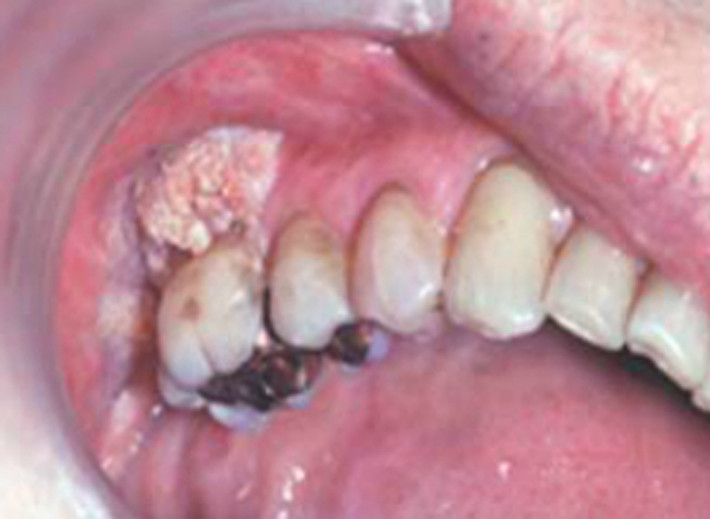Người bệnh trong tấm hình được chẩn đoán bị nhiễm nấm (histoplasmosis), anh ta có một vết loét ở nướu và nó cũng có xu hướng ngày càng lan rộng.