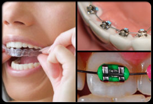 Đây là một số loại niềng răng cơ bản, trong một số trường hợp, khung niềng được giấu vào mặt bên trong của răng, hoặc cũng có thể dùng khung răng bằng nhựa trong suốt, hay còn gọi là "niềng
