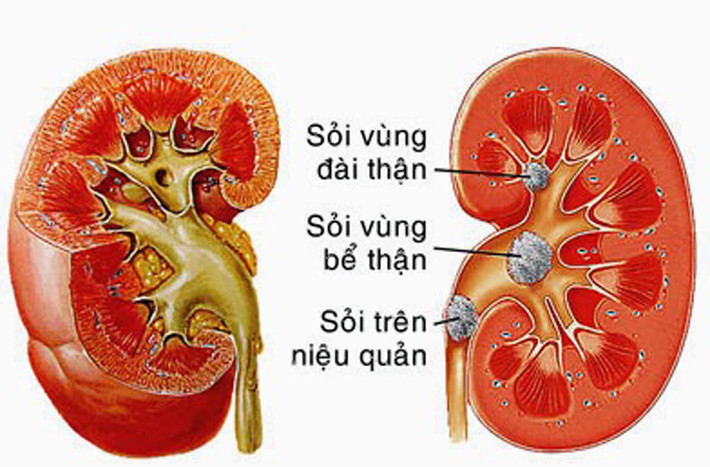 Khi cơ thể được cung cấp một lượng nước nhỏ, thành phần canxi sẽ có cơ hội kết hợp với muối và các khoáng chất khác hình thành nên sỏi thận.