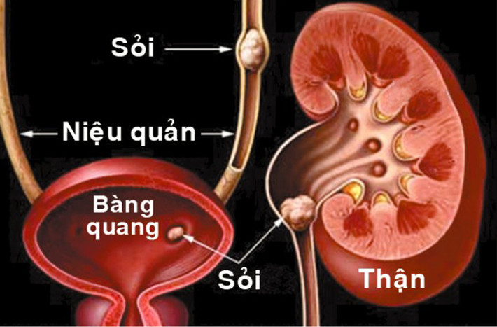 Bên cạnh đó, uống bia cũng có tác dụng lợi tiểu và làm giãn đường tiết niệu. Nhờ vậy, việc đào thải những hòn sỏi nhỏ trở nên dễ dàng và không gây đau đớn cho khổ chủ.