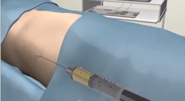 Chất béo thường được rút từ bộ phận nào đó trên người bệnh nhân có lượng mỡ dư thừa nhiều nhất, thường là vùng đùi.