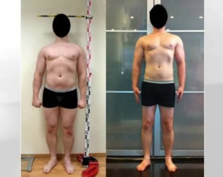 Phẫu thuật kéo dài tứ chi. Một người đàn ông ở New York đã cao thêm hơn 15cm sau khi trải qua ca phẫu thuật kéo dài tứ chi. Không những đau đớn và tốn nhiều thời gian, chi phí cho ca phẫu thuật này cũng lên tới 85.000 USD. Phẫu thuật kéo dài tứ chi giúp cho nhiều người đạt chiều cao mong muốn hoặc loại bỏ các dị tật.
