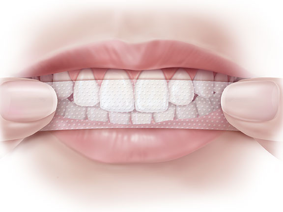 Nhanh gọn và hiệu quả tức thì - chính những đặc điểm ưu việt dễ thấy này đã khiến không ít người "ngang nhiên" sử dụng miếng làm trắng răng một cách đơn giản, thoải mái... như dùng kem đánh răng hàng ngày vậy.