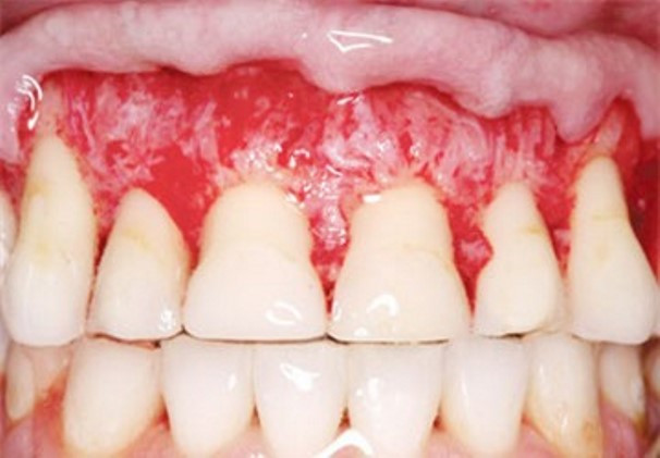 Thêm vào đó, các miếng dán không được thiết kế vừa vặn đúng hàm răng, bởi vậy mà khi dùng, chắc chắn bạn sẽ phải dán đè lên cả nướu hay chất hoá học trên miếng dán sẽ dây sang môi, lợi...