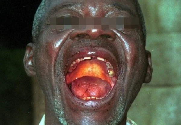 Ebola có thể vào Việt Nam qua con đường nào?