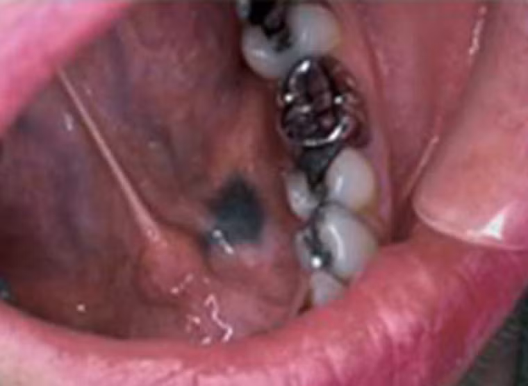 Còn đây là khoang miệng người phụ nữ 31 tuổi vừa được chẩn đoán mắc ung thư. Răng cùng một số mô xung quanh chuyển sang màu đen và có dấu hiệu di căn khá mạnh sang các tế bào khác.