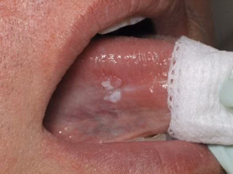 Lưỡi là “mảnh đất màu mỡ” nhất của ung thư miệng. Các dấu hiệu ung thư thường được tìm thấy ở hai bên và mặt dưới của lưỡi.