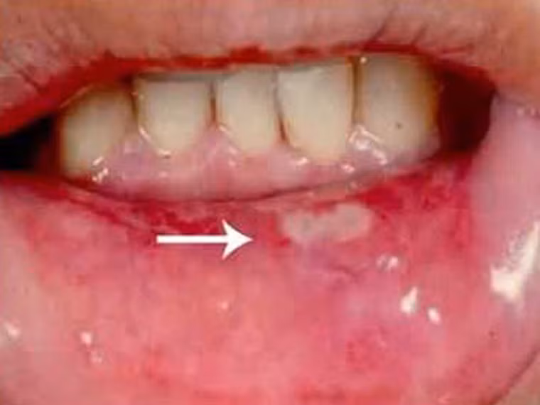 Ở Anh, khoảng 4.400 bệnh nhân ung thư miệng được phát hiện mỗi năm. Căn bệnh được mệnh danh là “tay sát thủ hung bạo” hơn cả ung thư tinh hoàn hay ung thư cổ tử cung ở nữ giới.
