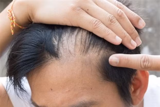 Nam giới hói đầu sớm hơn: Cuộc sống ngày nay thường có nhiều căng thẳng, bực bội. Kết quả là nhiều nam giới bắt đầu bị hói sớm từ khoảng 20 tuổi và điều này ngày càng phổ biến.