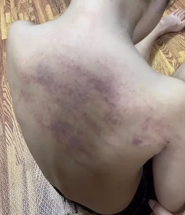 Kết quả giám định vụ bé 5 tuổi bị bầm tím lưng khi đi học Ket qua giam dinh vu be 5 tuoi bi bam tim lung khi di hoc
