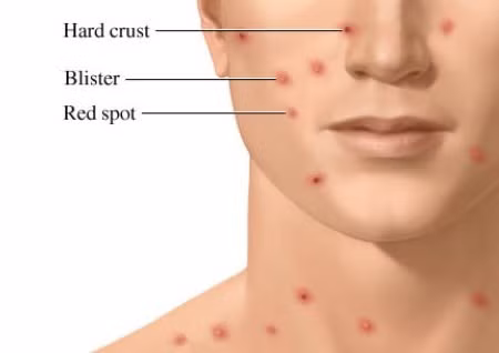 Mụn bóng nước lúc đầu chứa một chất dịch trong, khoảng 1 ngày sau trở nên đục như mủ rồi 2-3 ngày kế tiếp thì vỡ ra, các mụn sẽ đóng vẩy.