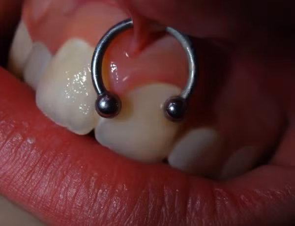 Xỏ khuyên xuyên mô lợi trên răng, môi. Kiểu xỏ khuyên này chỉ được phô ra khi chủ nhân của nó mở miệng cười.