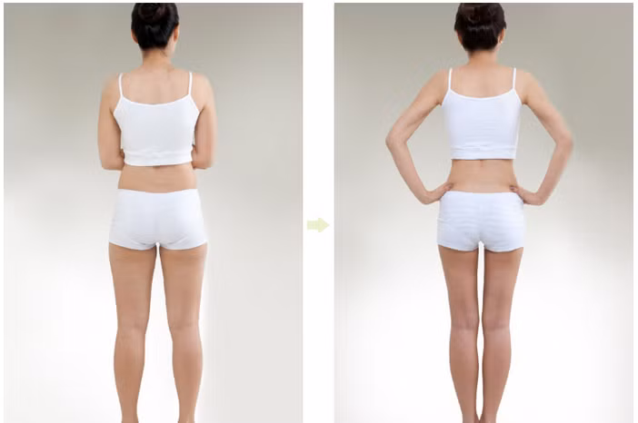 Cách 2: Cắt toàn bộ cơ sinh đôi. Bắp chân sẽ nhỏ đi nhiều sau khi cắt toàn bộ cơ sinh đôi. Tuy nhiên, nên nhớ rằng hình dáng của bắp chân quan trọng hơn là kích thước của bắp chân. So với bắp chân thon, bắp chân của phụ nữ có “bắp chân củ cải” thì cơ dầy hơn, như vậy thay vì làm lấy bỏ cơ bắp chân thì nên làm thế nào cho cơ mỏng đi. Hình dáng của bắp chân sau khi cắt toàn bộ cơ sinh đôi sẽ không tự nhiên.