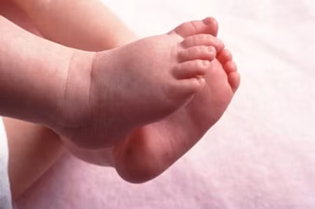 Tuyệt đối tránh 3 quan niệm sai lầm thường gặp sau đây: Kiêng tắm, kiêng gió – ủ trẻ quá kỹ – châm chích cho mụn nước mau vỡ ra, đây chính là những nguyên nhân làm cho bệnh của trẻ trầm trọng hơn và là con đường ngắn nhất của tình trạng bội nhiễm vi khuẩn rất nguy hiểm đến tính mạng của trẻ.