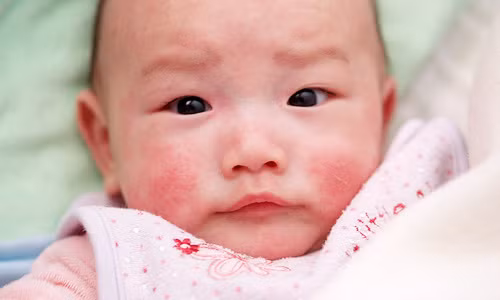 Quần áo, tã lót của trẻ bệnh nên được ngâm dung dịch sát khuẩn như dung dịch Cloramin B 2% hoặc luộc nước sôi trước khi được giặt sạch sẽ bằng xà phòng và nước sạch. Vật dụng cá nhân ăn uống của trẻ như bình sữa, ly uống nước, chén ăn cơm, muỗng ăn…nên được luộc sôi và sử dụng riêng biệt cho từng trẻ.