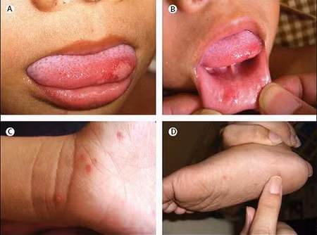 Sau đó đến giai đoạn toàn phát (có thể kéo dài 3-10 ngày) với các triệu chứng điển hình của bệnh: Loét miệng: vết loét đỏ hay phỏng nước đường kính 2-3mm ở niêm mạc miệng, lợi, lưỡi, gây đau miệng, bỏ ăn, bỏ bú, tăng tiết nước bọt.