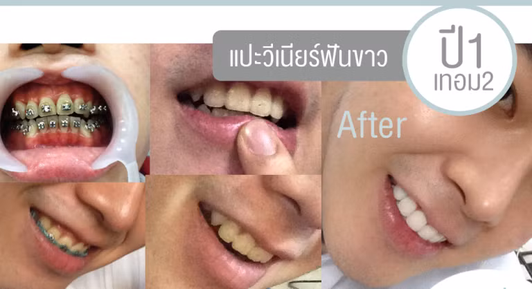 Công cuộc niềng răng và tẩy răng trắng sáng.