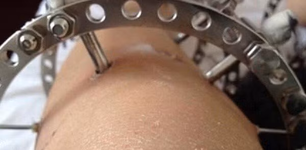 Sau khi cố định xương, cô gái phải nằm bất động 35 - 40 ngày. Đến khi tháo khung, chân vẫn luôn ở trong tình trạng rỉ máu. Nguyên lý của phương pháp kéo dài xương chân là cắt rời một chỗ trên đoạn xương chân cần kéo dài, xuyên các đinh chuyên dụng qua cả hai đoạn xương rời ra, rồi gắn vào một loại khung cố định đặc biệt ở bên ngoài chân.