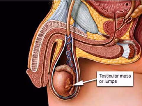 Những dấu hiệu khác lạ ở tinh hoàn cũng là một trong những biểu hiện của bệnh ung thư tinh hoàn. Đừng chủ quan, hãy đi khám bệnh nếu bạn thấy nó không ổn.