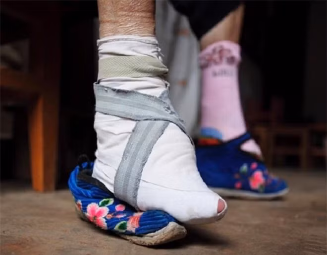 10. Bó chân: Chỉ khi có được đôi chân nhỏ nhắn, thon thả thì các thiếu nữ Trung Quốc mới mong lấy được chồng giàu sang. Trào lưu này thịnh hành gần 1.000 năm trước rồi bị hủy bỏ bởi tác hại lâu dài đối với sức khỏe. 