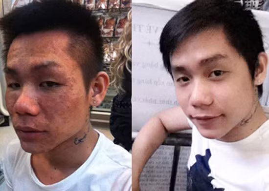 Khuôn mặt chàng trai bị biến đổi hoàn toàn trước và sau khi tắm trắng do dị ứng.