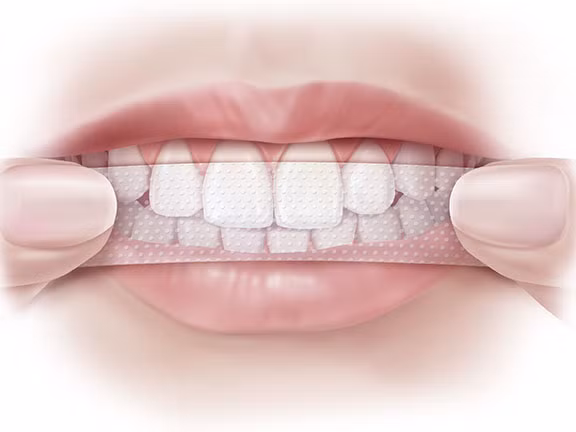 Nhanh gọn và hiệu quả tức thì - chính những đặc điểm ưu việt dễ thấy này đã khiến không ít người "ngang nhiên" sử dụng miếng làm trắng răng một cách đơn giản, thoải mái... như dùng kem đánh răng hàng ngày vậy.