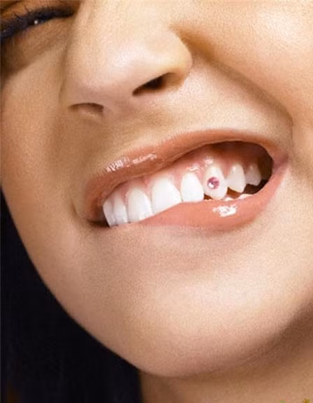 Ngày nay, nhiều bạn trẻ muốn “khẳng định đẳng cấp” bằng cách khoan răng, đính đá lên "bộ nhá".