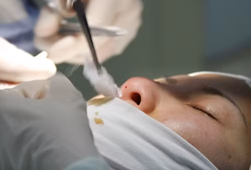 Bước 4: Bác sĩ đưa một miếng bông dài vào mũi bạn nhằm ngăn máu chảy trong quá trình tiểu phẫu lọt vào trong khoang mũi.