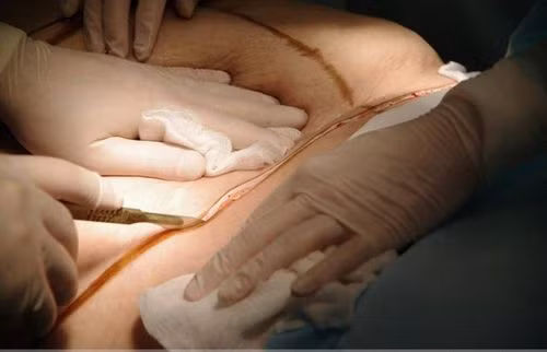 Sau đó, dựa vào đường vẽ, bác sĩ sẽ rạch những nhát rất ngọt trên bụng.