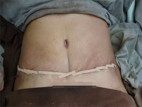 Sau khu hút mỡ, người bệnh sẽ bị đau ở vùng mổ vài ngày, bụng sưng, phù nề từ 1-2 tuần.