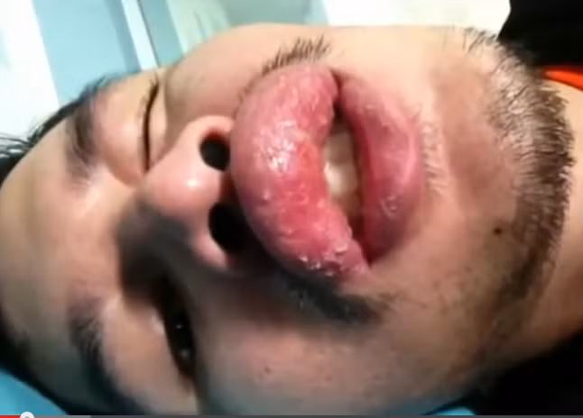 Môi sưng vù, đau đớn sau khi tiêm chất độn.